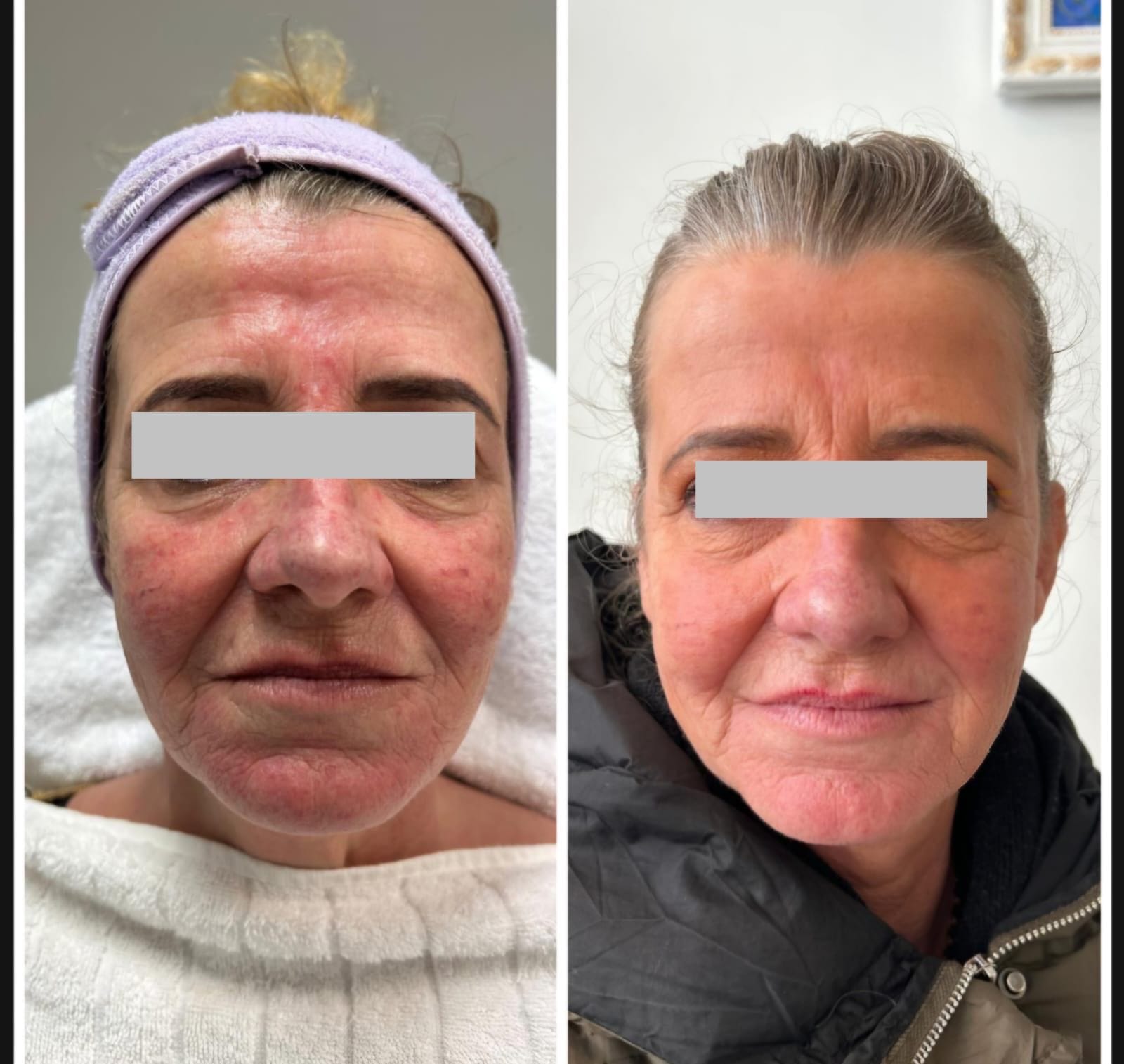 HIFU Behandeling resultaat Sara Clinic